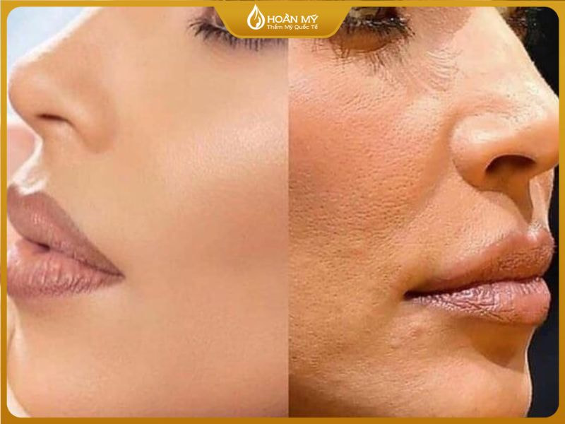 So sánh giữa 2 lớp nền trước và sau khi triệt lông mặt