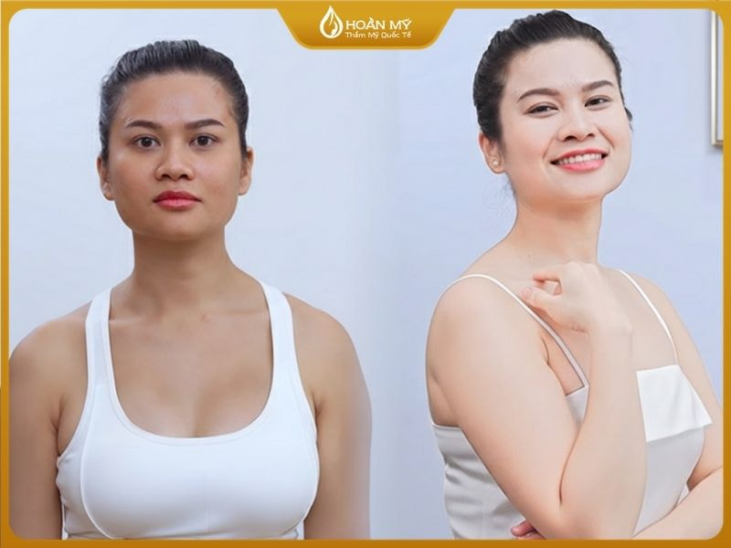 Trước và sau khi thực hiện liệu trình tắm trắng tại Hoàn Mỹ