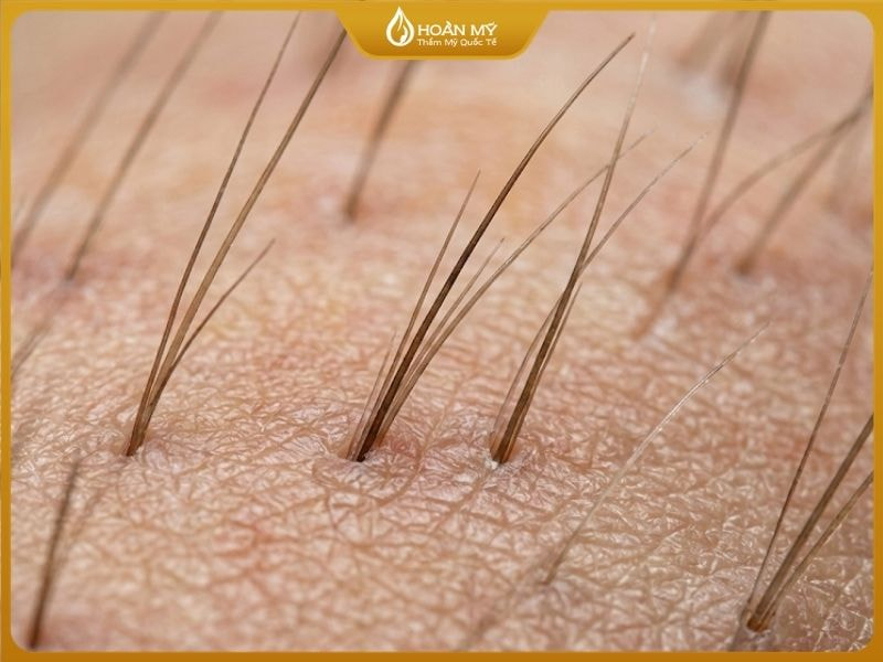 Cấu trúc sợi lông bị biến đổi màu sắc và hư tổn nặng sau khi tiếp xúc với hóa chất tẩy trắng mạnh