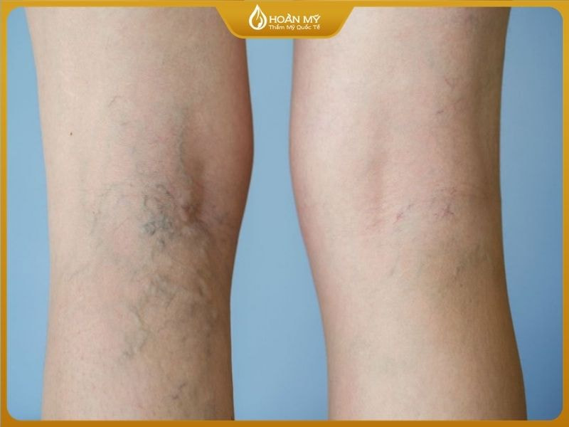 Kem trộn khiến da bị mỏng, yếu, lộ gân, sử dụng lâu có hại rất nhiều đến da