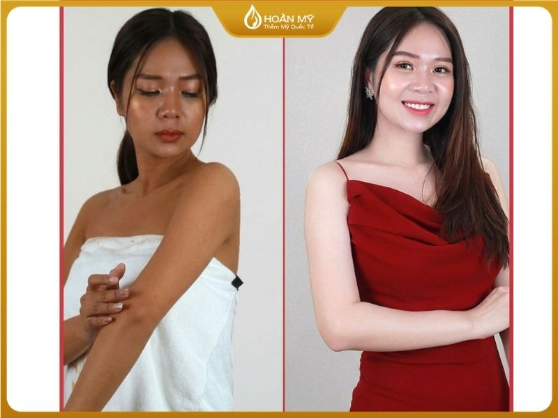 Trước và sau khi phun trắng Nano tại Hoàn Mỹ