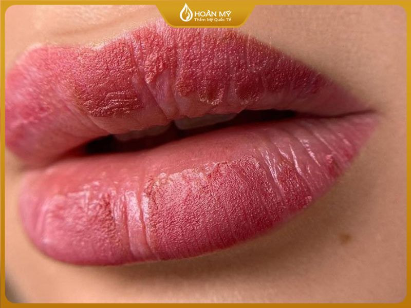 Cách Chăm Sóc Môi Sau Khi Phun Để Lên Màu Đẹp