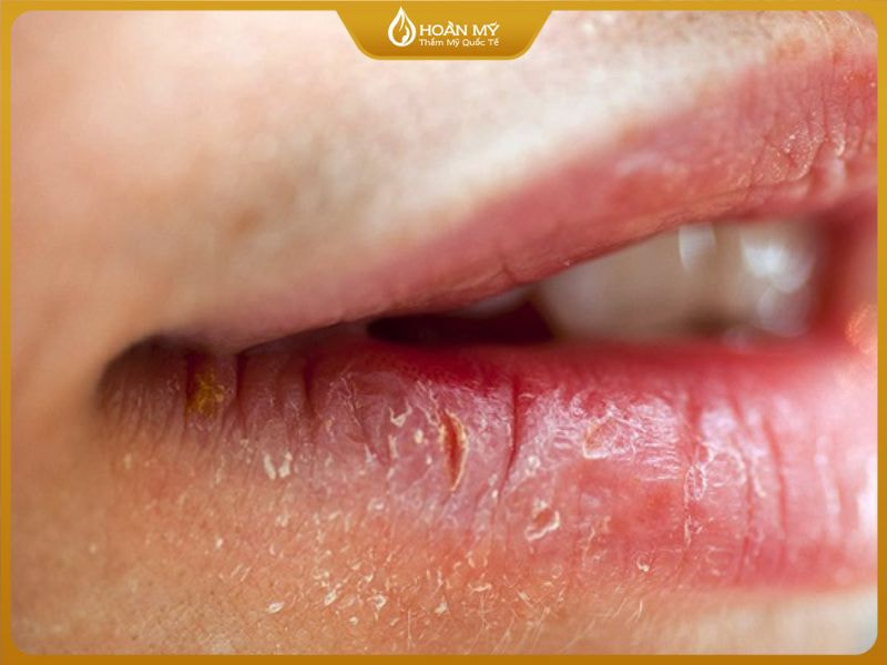 Môi khô, bong nhiều lần và không ổn định màu