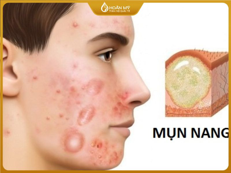 Mụn nang là gì?