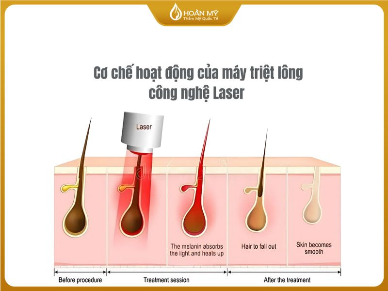 Cơ chế chọn lọc quang nhiệt (Selective Photothermolysis) tác động trực tiếp vào gốc lông