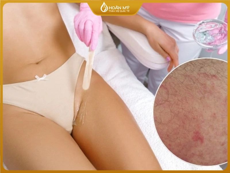 Wax lông làm đau rát da, chảy xệ và làm to lỗ chân lông