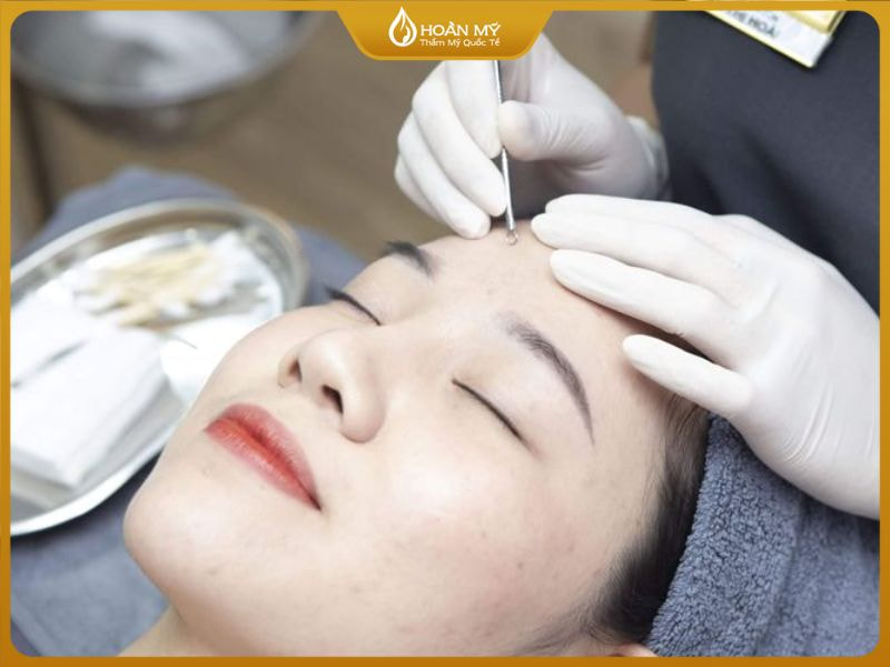 Quy trình điều trị mụn đầu đen và điều trị mụn đầu trắng chuẩn y khoa tại Thẩm mỹ Quốc tế Hoàn Mỹ.