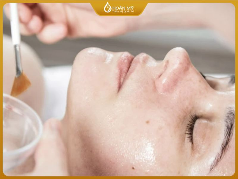 Điều trị mụn đầu đen/trắng bằng phương pháp peel da