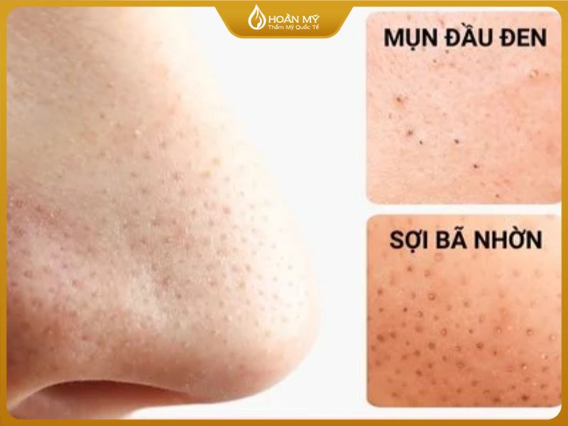 Các nguyên nhân dẫn đến tình trạng mụn đầu đen/trắng là do: tuyến bã nhờn, nội tiết tố và cách vệ sinh