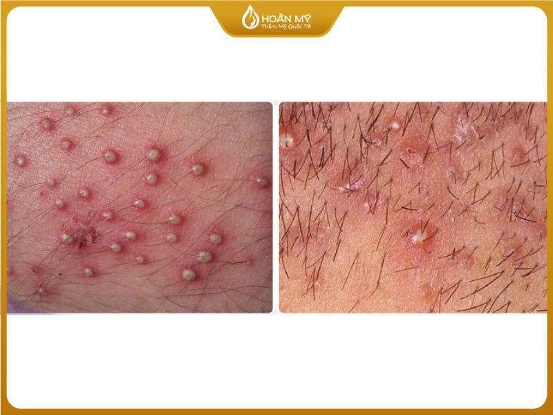 Lông mọc ngược tại vùng kín