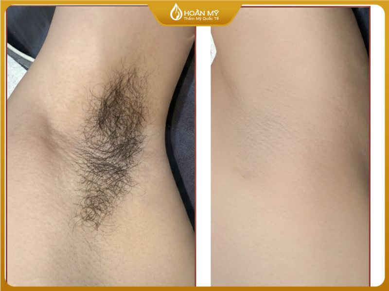 Sự thay đổi của làn da nách: buổi 1 lông rậm đen, buổi 10 da trắng mịn và không còn thấy rõ lỗ chân lông