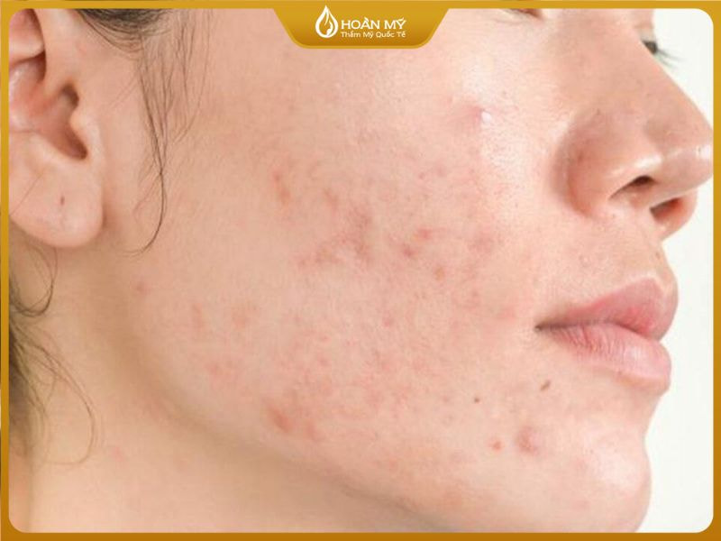 Lông mặt dày rậm khiến vi khuẩn dễ trú ngụ từ đó sản sinh mụn