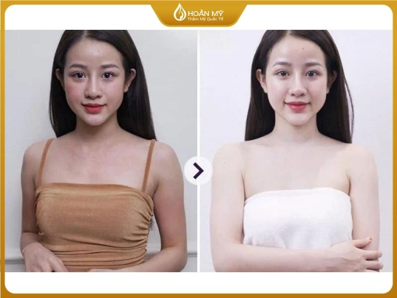 So sánh làn da trước và sau khi thực hiện liệu trình tắm trắng phi thuyền