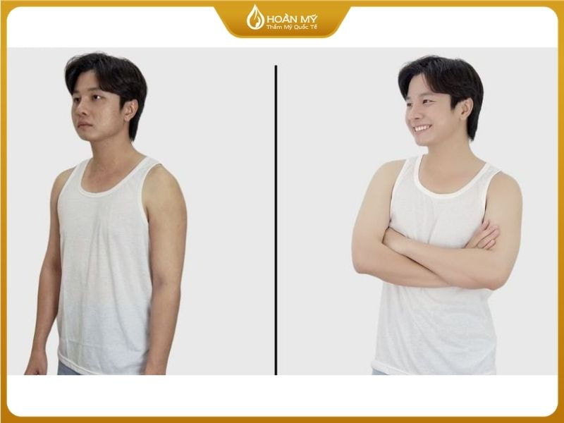 Trước và sau khi thực hiện liệu trình tắm trắng cho nam giới