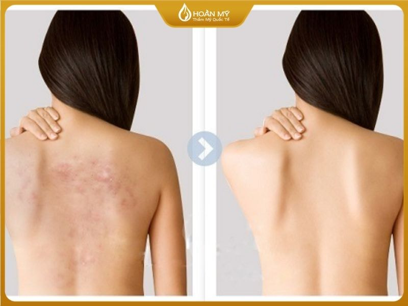 Tắm trắng giúp lấy đi độc tố tích tụ dưới da làm thông thoáng lỗ chân lông