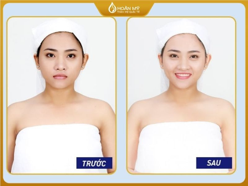 Trước và sau khi thực hiện liệu trình tắm trắng tại Hoàn Mỹ