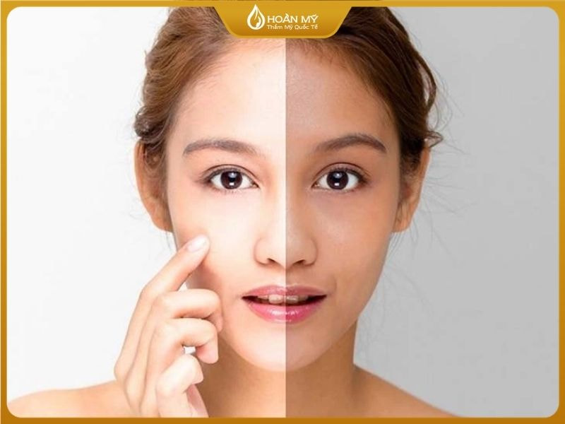 Da đen bẩm sinh khi thực hiện đủ liệu trình da sẽ trắng bật tông 