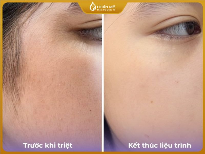 Kết quả triệt lông vĩnh viễn giúp da sáng mịn và se khít lỗ chân lông tại Hoàn Mỹ