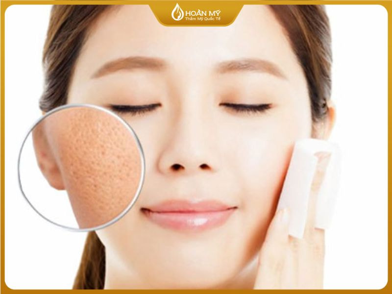 Triệt lông mặt giúp se khít lỗ chân lông và ngăn ngừa vi khuẩn P.acnes gây mụn