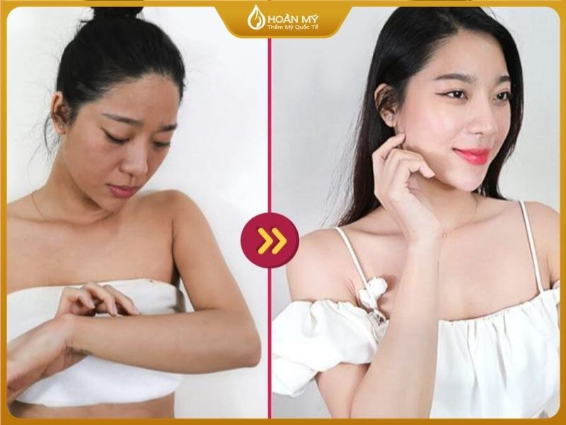 Trước và sau khi khách hàng thực hiện liệu trình tắm trắng tại Hoàn Mỹ