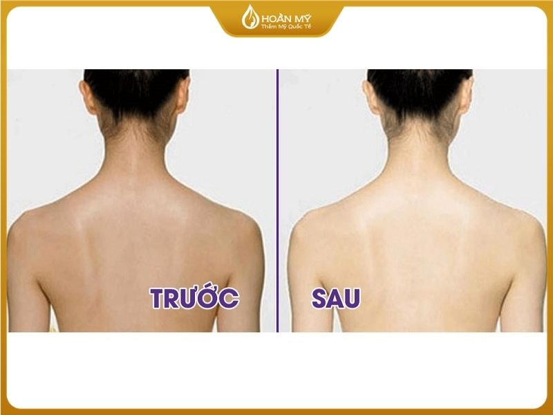 Trước và sau khi tắm trắng phi thuyền tại Hoàn Mỹ