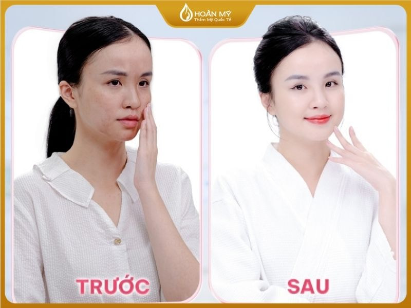 Trước và sau khi tắm trắng phi thuyền tại nhà Hoàn Mỹ