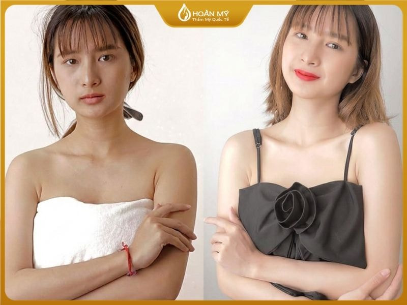 Trước và sau khi thực hiện liệu trình tắm trắng phi thuyền tại nhà Hoàn Mỹ