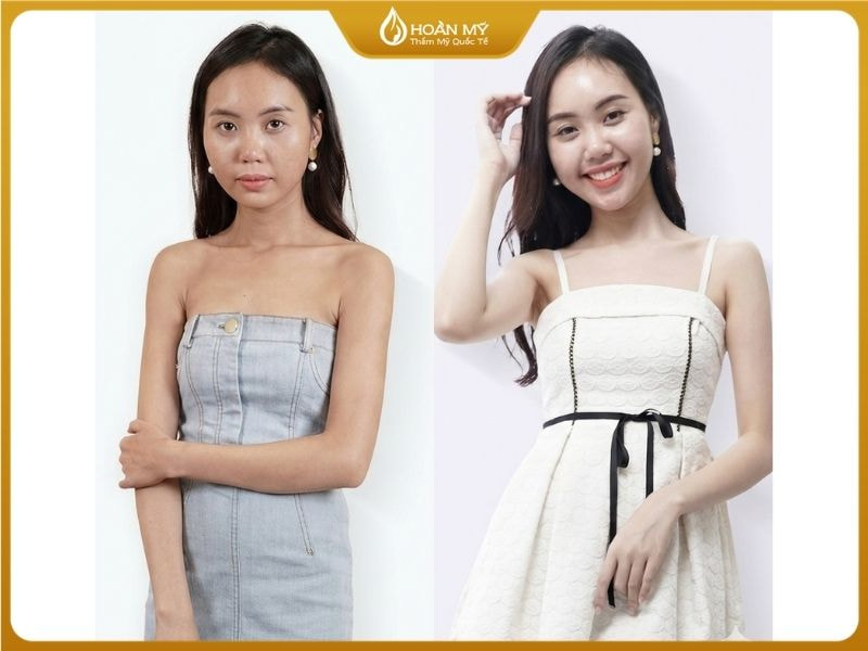 Tắm trắng là gì? Cơ chế nâng tông da khoa học và an toàn