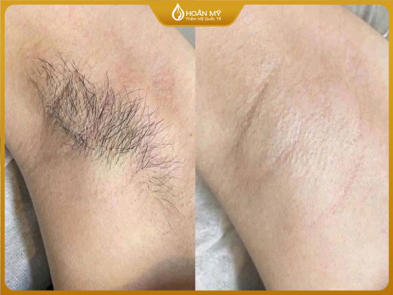 So sánh trước và sau khi triệt lông nách tại Hoàn Mỹ: Lông sạch hoàn toàn, lỗ chân lông thu nhỏ và da trắng sáng rõ rệt