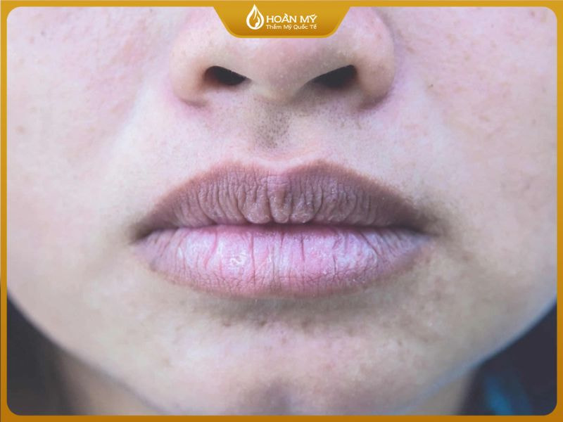 Người có môi thâm, xỉn màu hoặc không đều sắc tố