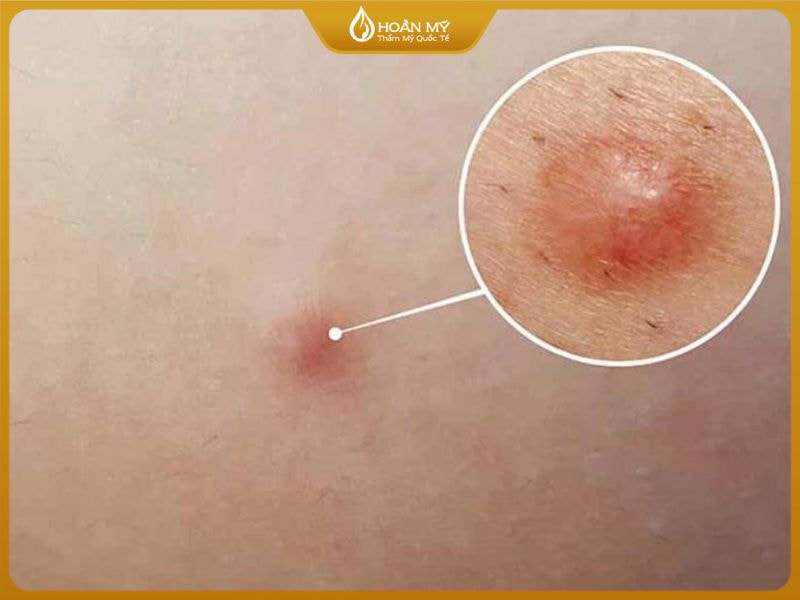 Mụn dưới da nằm ẩn sâu dưới lớp biểu bì da