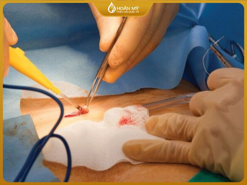 Điều trị mụn áp xe bằng phương pháp y khoa