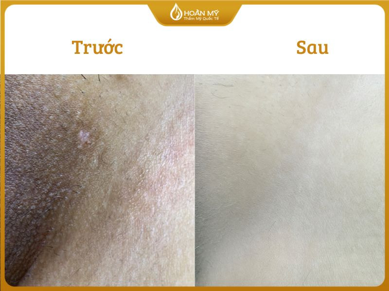 Sự thay đổi sắc tố da vùng bẹn: trước triệt bị thâm sần, sau triệt mịn màng trắng hồng