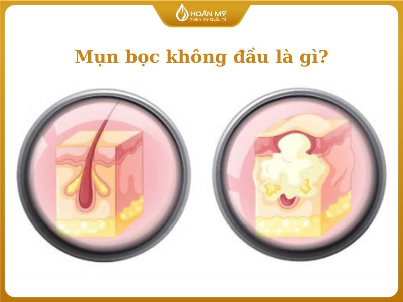 Mụn bọc không đầu nằm sâu dưới da và không có nhân mụn trồi lên