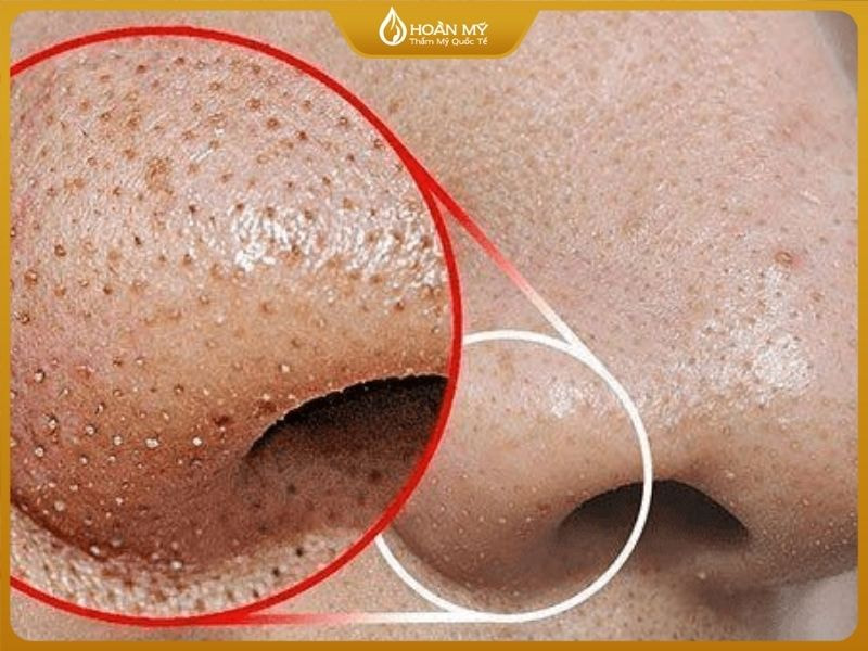 Dấu hiệu nhận biết mụn cám: sần sùi và làm mất thẩm mỹ
