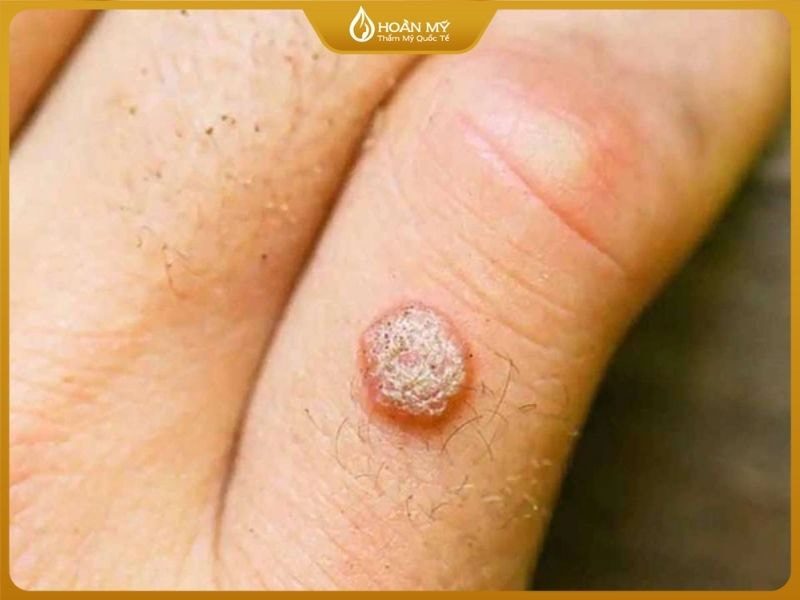 Mụn cóc là những nốt sần cứng nhô lên trên bề mặt da