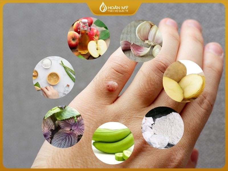 Trị mụn cóc bằng mẹo dân gian như: tỏi, chuối xanh, lá tía tô, giấm táo, nha đam, khoai tây hoặc vôi tôi