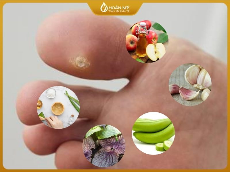 Điều trị mụn cóc bằng các nguyên liệu thiên nhiên tại nhà