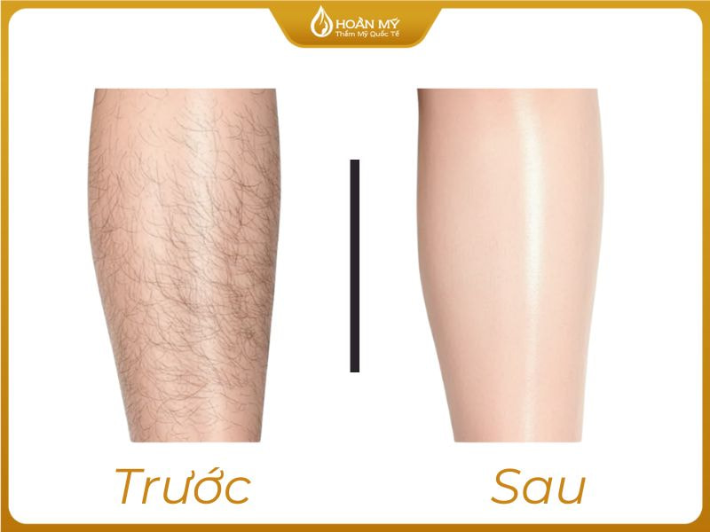 Triệt lông có hết vĩnh viễn không? Sự thật về hiệu quả và chu kỳ mọc lại