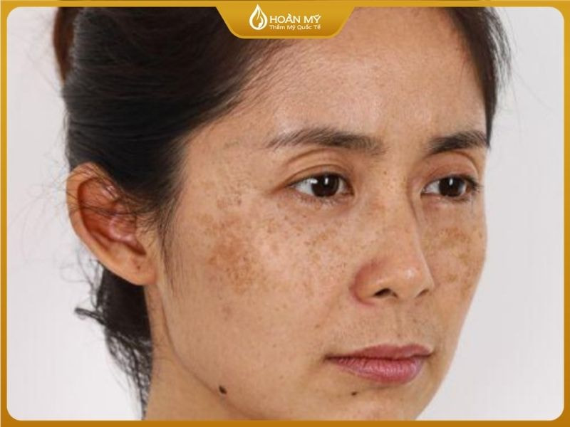 Da sẽ trở nên sạm, nám, tàn nhan, khô nếu không có chống nắng