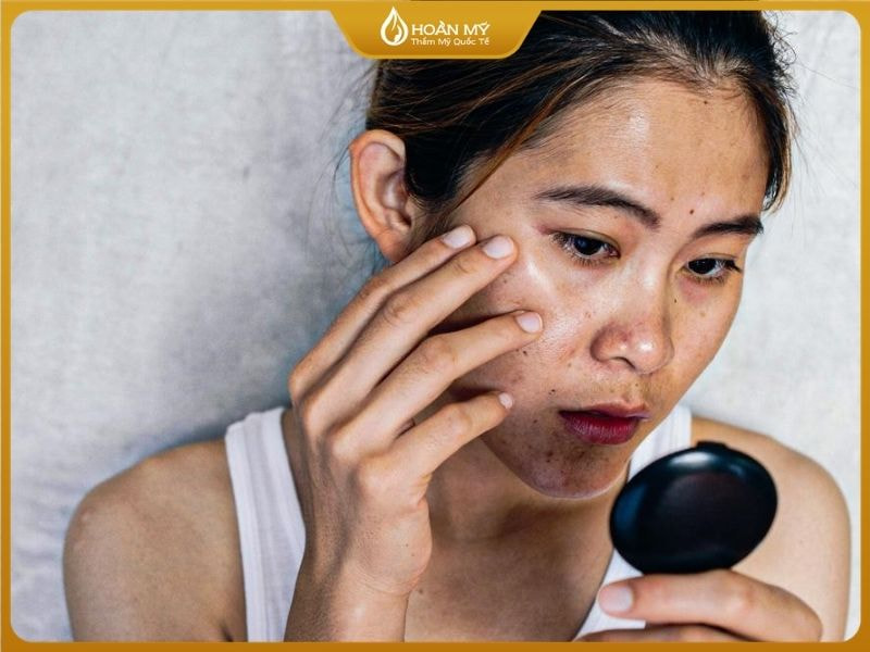 Làn da mặt đen sạm là nỗi tự ti của nhiều chị em