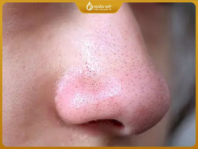 Mụn đầu đen xuất hiện dưới hình dạng những chấm đen li ti trên mũi