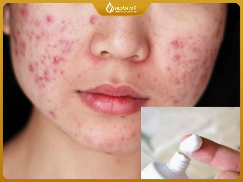 Lạm dụng thuốc dẫn đến tình trạng da kích ứng và nổi mụn