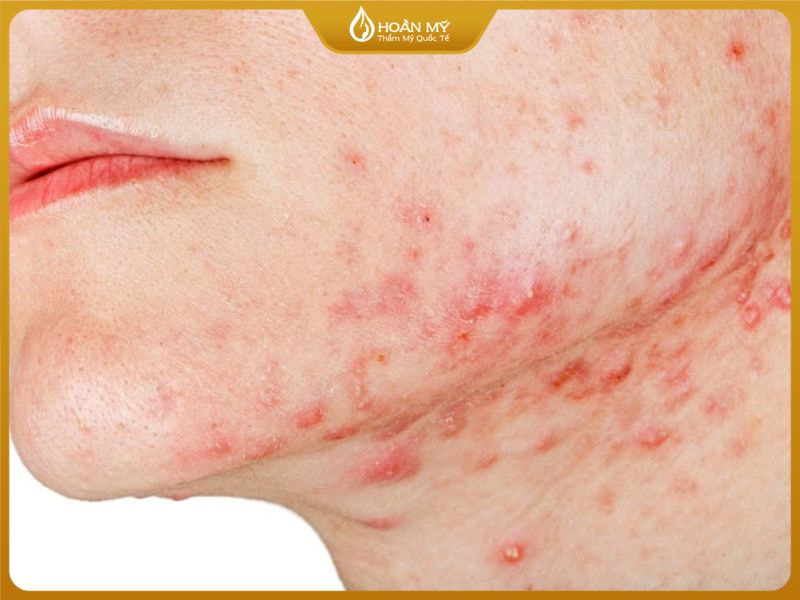 Mụn mọc thành cụm và sưng đỏ ở quai hàm