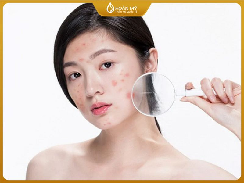 Vệ sinh mặt chưa đúng cách dẫn đến việc mụn hình thành
