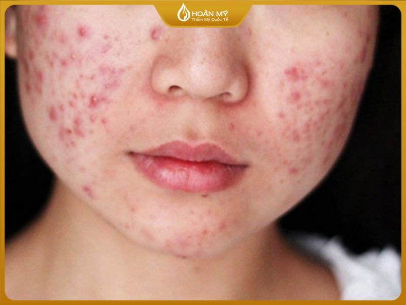 Trị mụn giá bao nhiêu? Khi nào cần đến gặp bác sĩ?