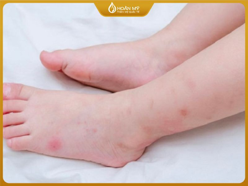 Mụn mắt cá chân không quá nguy hiểm nhưng gây khó chịu và mất thẩm mỹ