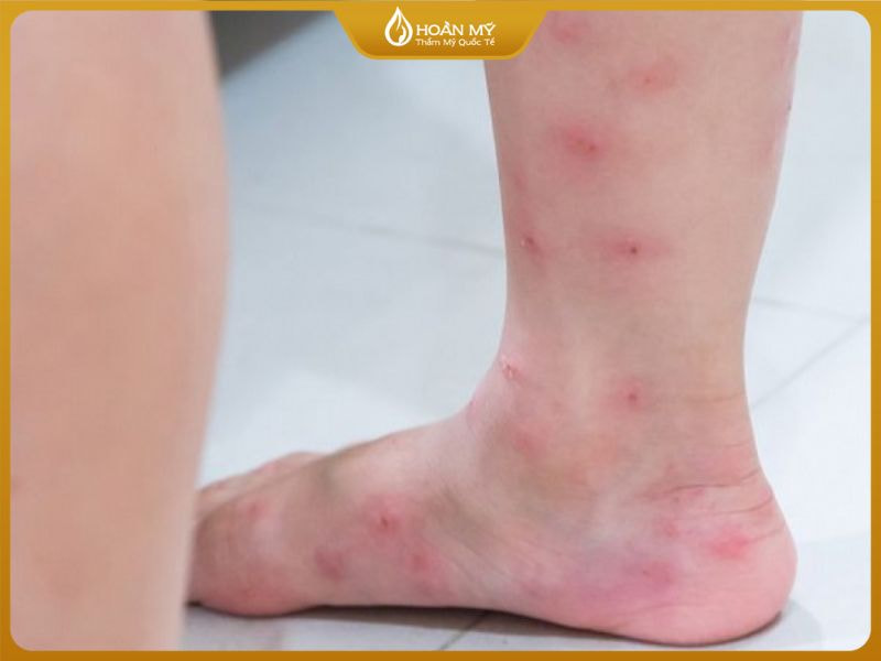 Các biểu hiện khi mụn xuất hiện ở mắt cá chân: nốt đỏ, sưng, viêm