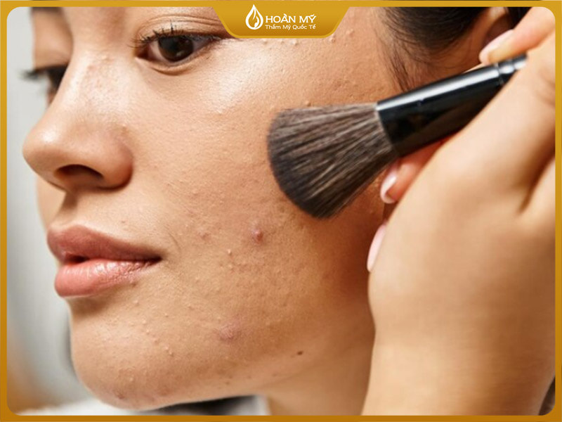 Make up lên da mụn khiến da “khó thở” giảm khả năng tự phục hồi