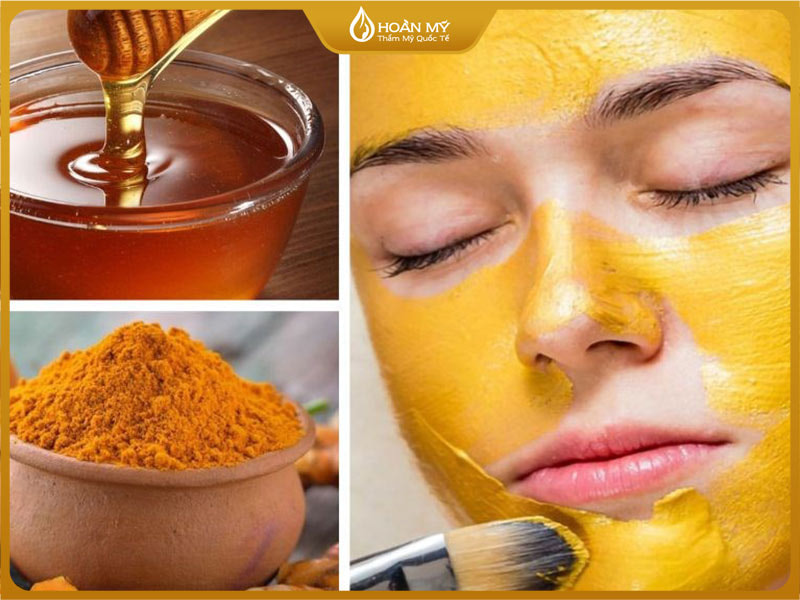 Mặt nạ nghệ và mật ong giúp kháng khuẩn, giảm viêm, giảm thâm và giúp làm dịu nốt mụn
